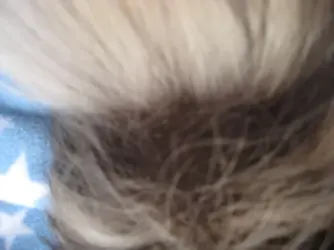 Betsy Hair loss 5.webp