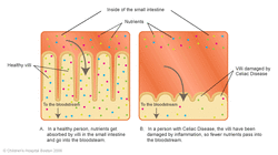 celiac_intestine2.gif celiac_intestine2.gif