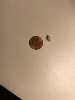 bladder stone.webp