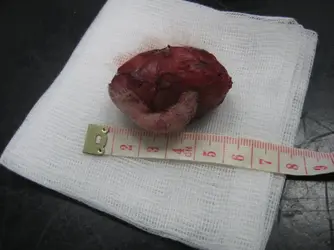 Christian Abscess 1.webp Christian Abscess 1.webp